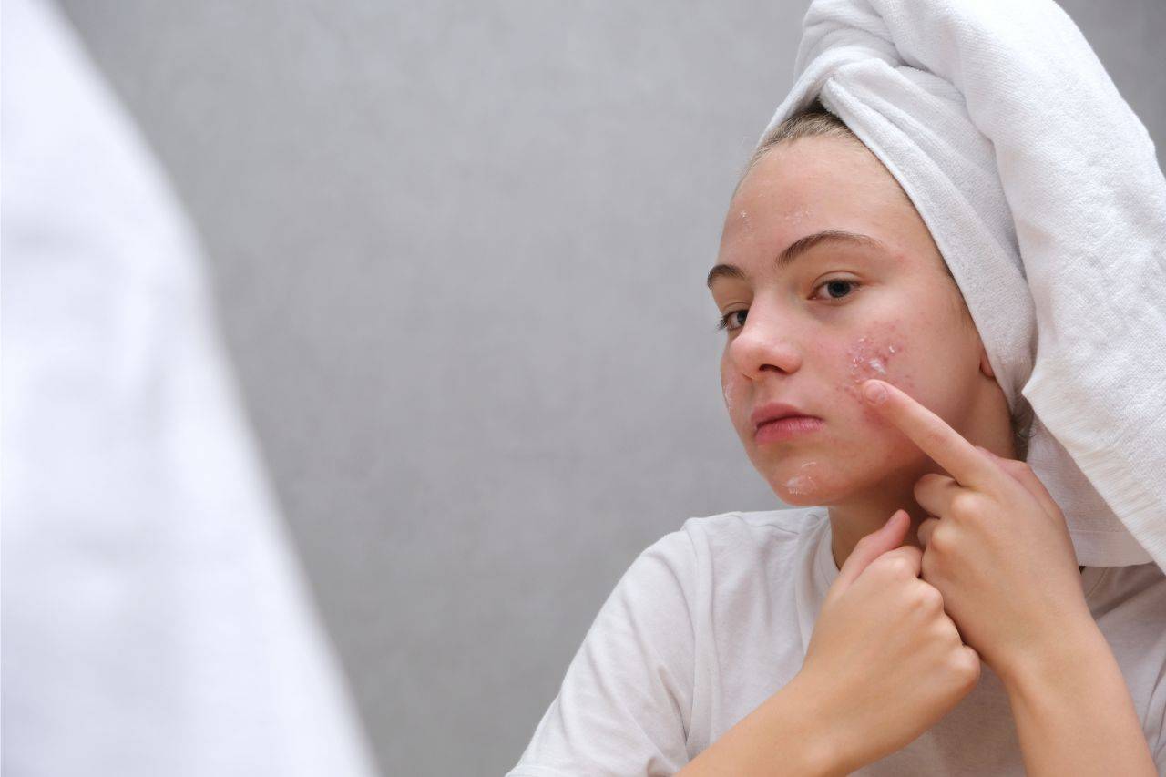 Welche Sonnencreme bei Akne? Adieu Pickel & Unreine Haut